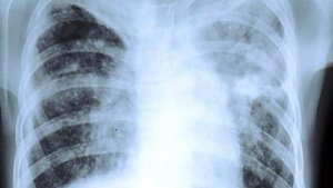 Клинический метод диагностики туберкулеза